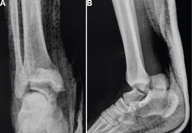 Anteroposterior (A) and lateral (B) view radiographs of the ankle showing fracture neck of talus with posterior extrusion of talar body.